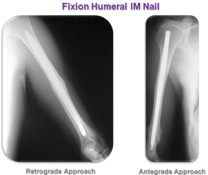 Fixion Humeral Interlocking Nail , Interlocking nail , fixion nail , humeral nail