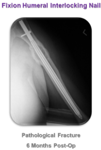 Fixion Humeral Nail , fixion nail , humeral nail , Fixion Humeral interlocking Nail , interlocking nail