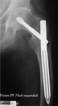 fixion expandable nail , expandable nail , Fixion PF Nailing System , proximal femur nail