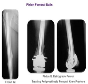 Fixion Femoral Nail, femoral nail