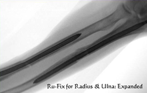 expandable radius & ulna nail