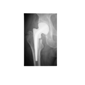 Hip Spacer